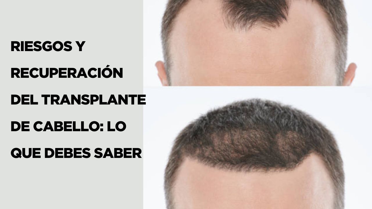 Transplante de Cabello: Lo Que Debes Saber