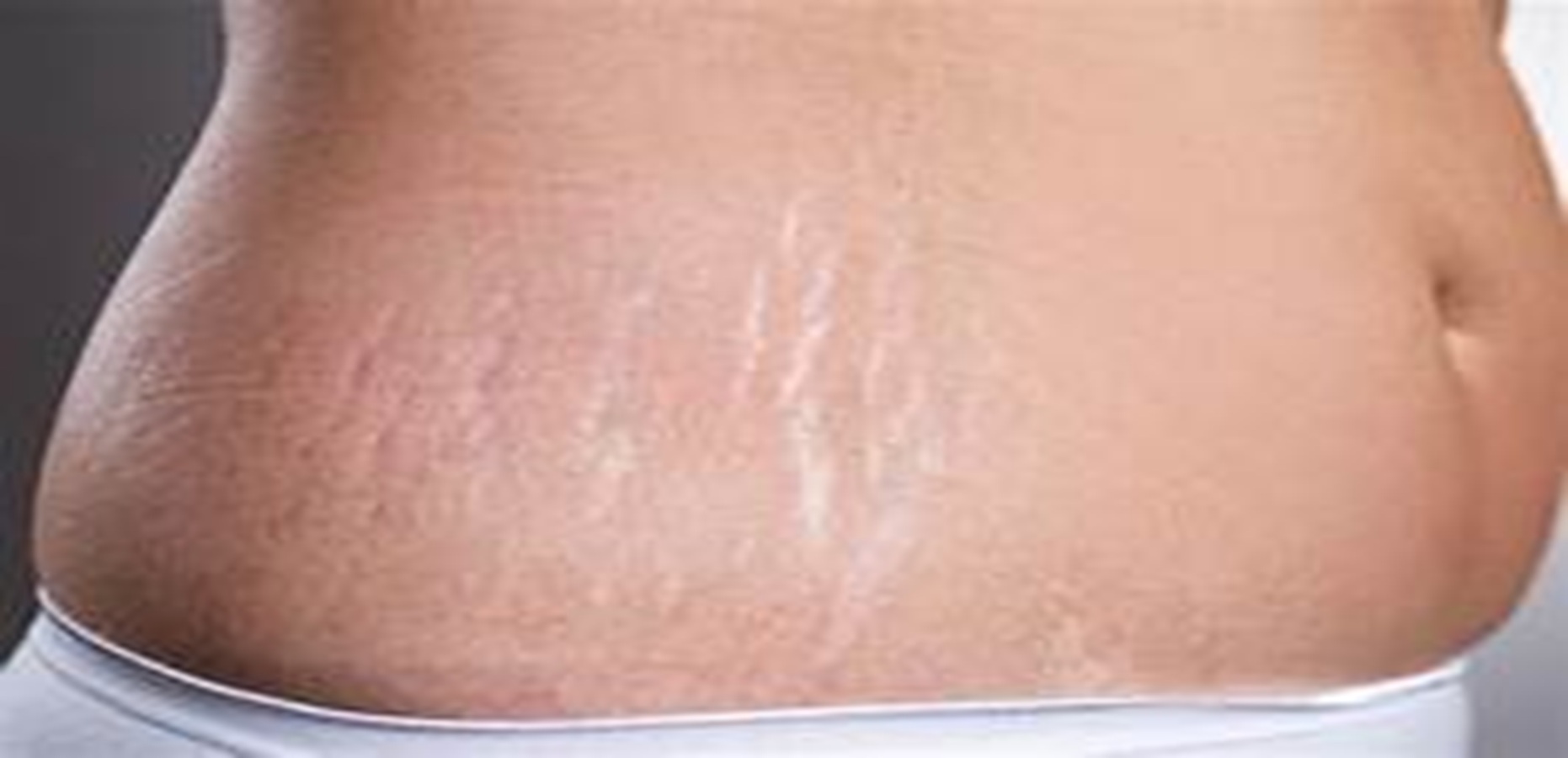 Stretch Mark Removal Treatment in India
